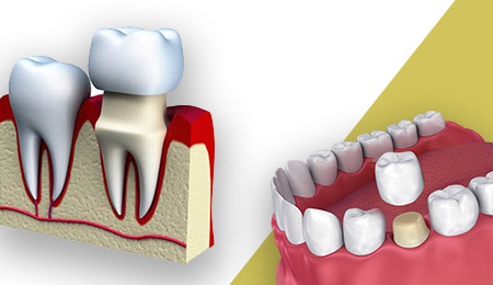 corone dentali