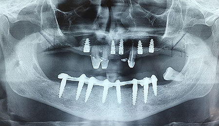 radiogragia dentale