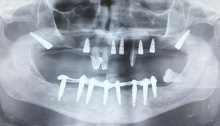 radiogragia dentale1