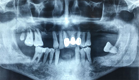 radiogragia dentale2